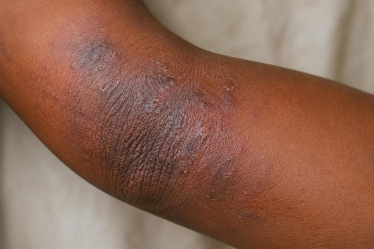 Close-up of dry, irritated eczema-prone skin on a Black person's arm